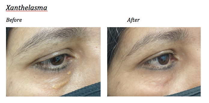 how do i remove cholesterol deposits under eyes